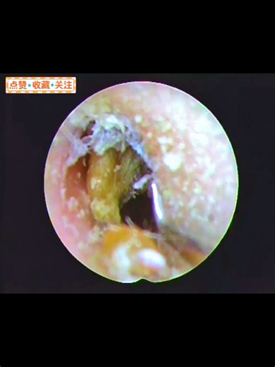 硬核预警，这般耳道清理少见又过瘾#上头 #relaxing #satisfyingvideo #EarCleaning #可视采耳 #掏耳 #耳屎 #耳垢 #强迫症 #沉浸式 #耳朵 #清除 #极度舒适服 #清理 #解压 #不可思議 #解压视频 #掏耳朵 #asmr