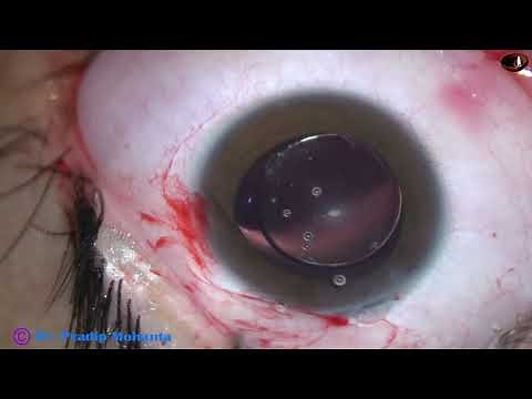 Clear Lens Extraction with IOL implantation for a highly myopic eye : Pradip Mohanta, 13 June, 2021