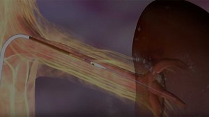 The Peregrine System™ Infusion Catheter (Peregrine Catheter)