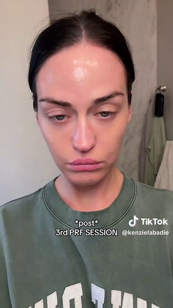 Effective PRF Injections for Skin Rejuvenation