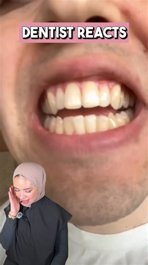 Dr Soumaya Zinet 💍 on Instagram: "Here’s why an open bite makes it impossible to bite food properly 😬 And how Invisalign actually fixes it If you want real explanations from an actual Invisalign expert follow for more teeth alignment breakdowns! #invisalignuk #teethalignment #openbitefix #cosmeticdentist"