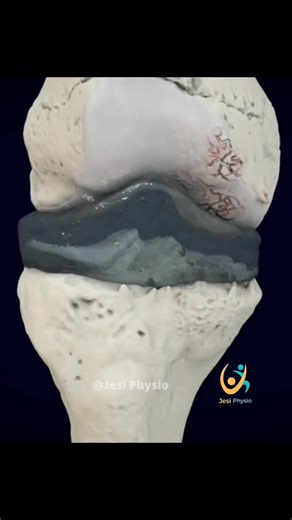 L'Acide Hyaluronique est un polysaccharide (un sucre complexe) qu'on retrouve dans les tissus mous de notre corps ou encore dans le liquide synovial (le lubrifiant de nos articulations). 💧 C'est un gel qui a une certaine viscosité. Il a des propriétés hydratantes, lubrifiantes, élastiques et régénératives qui l'ont rendu fort intéréssant dans la médecine moderne. Et également en cosmétique. Il est aujourd'hui produit par l'industrie de manière artificielle par des processus de dégradation de ba