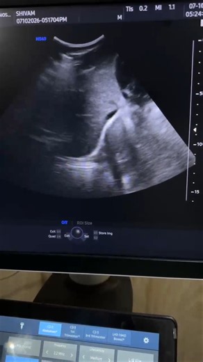 🩺 Abdominal Ultrasound Anatomy | Real-Time Sonography #shots #ytshorts #youtubeshorts #ultrasound