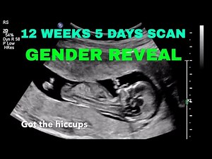 12 weeks 5 days Ultrasound/ GENDER REVEAL