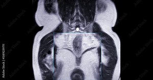 MRI scan reveals an enlarged prostate gland, a possible indicator of prostate cancer. Explore the critical signs and how MRI can assist in early detection.