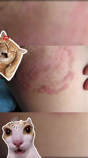 J Gatal sangat teruk! Macam mana nak hilangkan? #MasalahKurap #HilangkanKurap #RawatanKurap #KrimKurap #HerbaKurap #PenyakitKulit