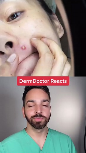 Dermatologist's Pimple Popping Procedure with Dr. Maxfield and Dr. Shah