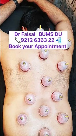 #Hijama Therapy #Cupping #Herbal #unani #Treatment