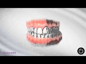 Unilateral Posterior Crossbite