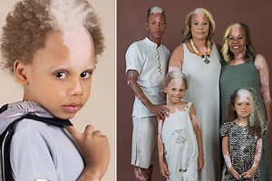 Boy with rare skin condition becomes ‘supermodel’ — and it runs in his family