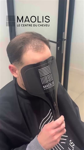 Le complément capillaire au niveau supérieur , naturel, invisible, aucune sensation #maolis #complementcapillaire #prothesecapillaire #perruque #implant | Maolis