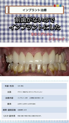 インプラント ビフォーアフター 前歯がないのでインプラントにした 【Before & After】 #インプラント治療＃きさくデンタル＃歯医者