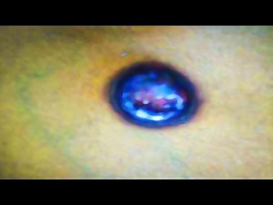 Blackhead, Black Heads and Blackheads!