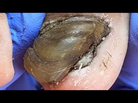 Black Toenails, Clean Step By Step To The End【Xue Yidao】