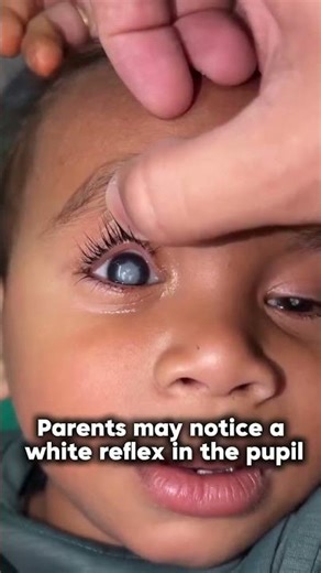 Squint Surgery Truth It Corrects Alignment, Not Eye Movement