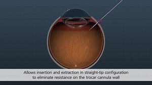 VEKTOR™ Articulating Illuminated Laser Probe | Alcon Professional