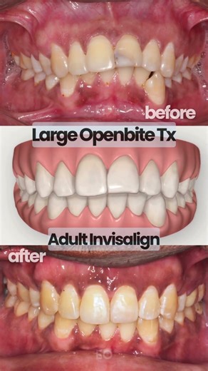 Incredible Large Openbite correction with Invisalign ✨#orthodontics #invisaligntreatment #dentist