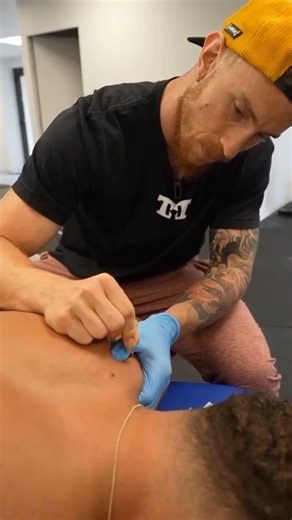 Je pique un bodybuilder professionnel 😱 Le dry needling… Cette technique fascine autant qu’elle interroge... Alors, effet placebo ou réelle efficacité ? 🤔 Le dry needling consiste à insérer des aiguilles dans les points trigger myofasciaux pour (potentiellement) relâcher les tensions musculaires et réduire la douleur, tout en améliorant la fonction immédiatement après (Lew, 2021 ; Pourahmadi, 2021 ; Vázquez-Justes, 2022 ; Rhys, 2023 ; Ma, 2024 ; ). Contrairement aux idées reçues, les preuves s