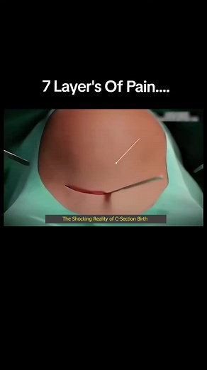 7 Layer's of pain, The shocking reality of C-section Birth #csectionbirth #csectionbirthpain #viraltiktok #babydelivery #pregnancyjourney