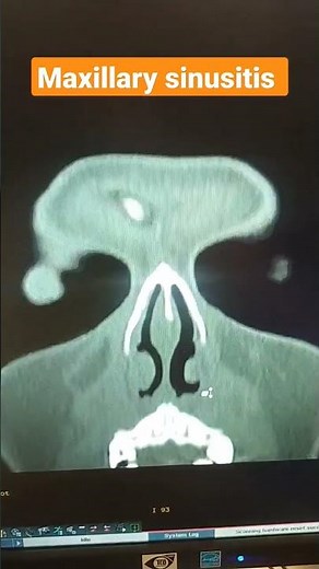 Mild mucosal thickening in bilateral maxillary sinus. #mri #ct #sinuses #shorts