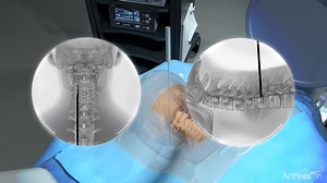 Posterior Cervical Endoscopic Foraminotomy