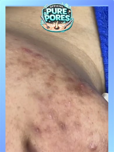 #9 - Shorts2 - Official Pure Pores Skin Care React to Soothing facial treatments ASMR @officialpurepores #blackheadremoval #pimplepopping #acneextraction Voice reaction and animations to Extreme blackhead removal, deep pore cleansing, intense acne extraction and satisfying skincare close-ups captured in HD and 4K macro detail. This video features real pimple popping, whitehead extraction, nose pore cleaning and deep skin cleansing designed to be relaxing and oddly satisfying. Watch clogged pores