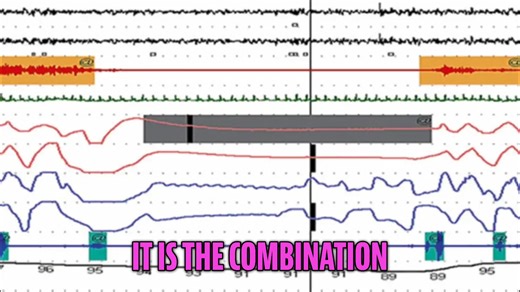 Mixed apnea combines central and obstructive types. It typically begins with a central component, then shifts to obstructive as effort starts before flow ends. Recognizing the difference is key. #MixedApnea #SleepApnea #CentralApnea #ObstructiveApnea #SleepDisorders | Global Sleep Academy | Facebook