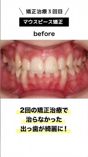 【月額3000円〜／リスク:疼痛等】※詳細は必ず展開してご確認ください•マウスピースを用いた矯正歯科※自由診療/期間・通院回数：6ヶ月〜2年・3〜6回 /施術のリスク: 疼痛、咬合痛、歯根露出等