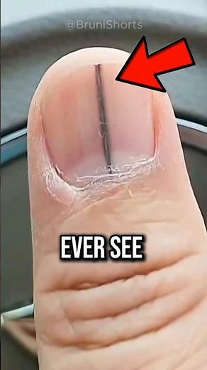 Black Nail Line is Cancer ?😨