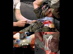 How to apply the Israeli pressure dressing.