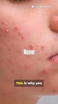 Acne Explained: Causes, Symptoms & Best Treatments
