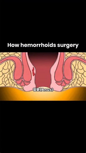 Animated Health Explainers on Instagram: "Hemorrhoids surgery is done when piles are severe, painful, or don’t improve with medicines and lifestyle changes. Common procedures include hemorrhoidectomy (removal of hemorrhoids), stapled hemorrhoidopexy, and rubber band ligation. Surgery helps relieve pain, bleeding, itching, and prolapse. Recovery usually takes a few days to weeks, with advice to eat high-fiber foods, drink plenty of water, and avoid straining. #Hemorrhoids #Piles #HemorrhoidSurger