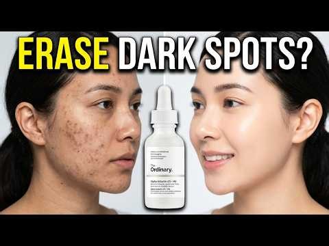 Remove Acne Marks & Dark Spots! The Medical Truth About The Ordinary Alpha Arbutin 2% + HA