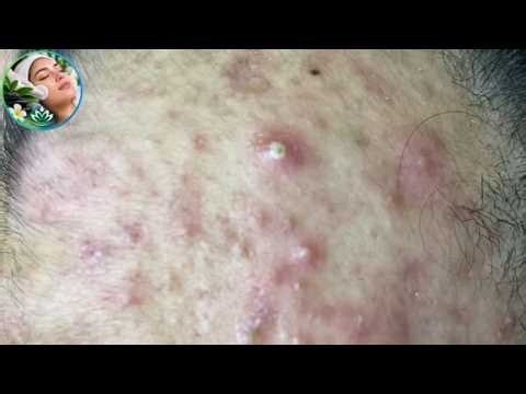 Ultimate Extreme Pimple Pop The Most Satisfying Extraction Yet!