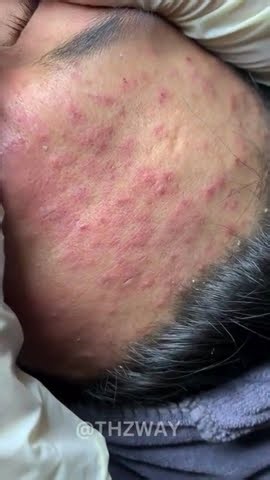 Acne Extraction on nose #satisfying #asmr #relaxingtriggers #blackheadremoval