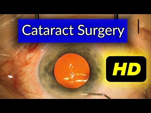Cataract Surgery | Explained by an Ophthalmologist