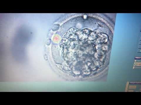Laser Assisted Hatching Blastocyst