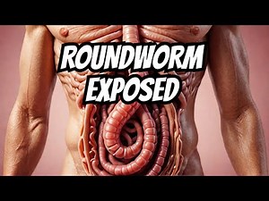 Ascariasis Explained: The Shocking Truth About the Intestinal Roundworm Infection!