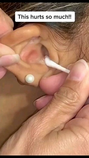 Pimple Content⚠️ | That hurts🙄 Ear Pickers🔥LINK IN BIO . #earendoscope #earcleaning #earwax #earcleaner #earwaxremoval #explore #beautyproducts #beautytips... | Instagram