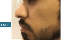 Reducing a Nose Hump — See This Simulation