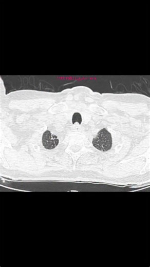 Shruthi P on Instagram: "66 year old gentleman with chronic persistent cough. Radiograph acquired 1 month back shows consolidation in right lower zone. Diagnosis ? Histopathology: Lepidic predominant adenocarcinoma Lepidic-predominant adenocarcinoma of the lung, formerly known as non-mucinous bronchoalveolar carcinoma, is a subtype of invasive adenocarcinoma of the lung characterized histologically when the lepidic component comprises the majority of the lesion. CT While non-specific CT features