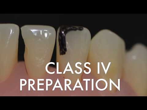 Class IV Preparation for Resin Composite