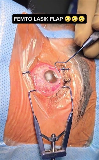 Femto lasik Flap #visioncaremeerut