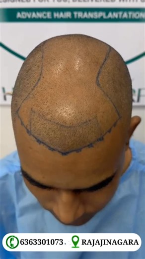 HRF HAIR CLINIC on Instagram: "Happy client Book your appointments now Bangalore. Rajajinagar #hair #hairtransplant #prp #gfc"
