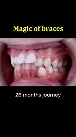 Magic of braces: Fix crooked teeth in 25 months duration #orthodontics #brackets #dentist #braces