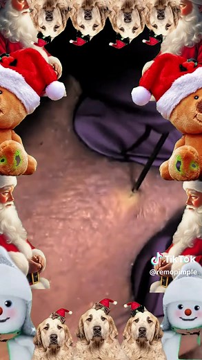 remopimple on TikTok