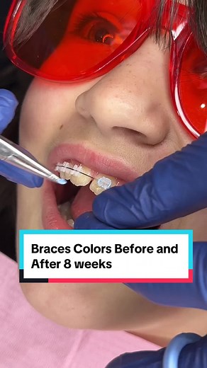 Before and After: Sky Blue and Teal Braces Transformation