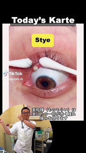 #医者 #麦粒腫 #ものもらい #stye #doctor #doctorsoftiktok @Diana Garcia