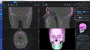 How to – Segment upper and lower jaws in a CBCT image in Planmeca Romexis
