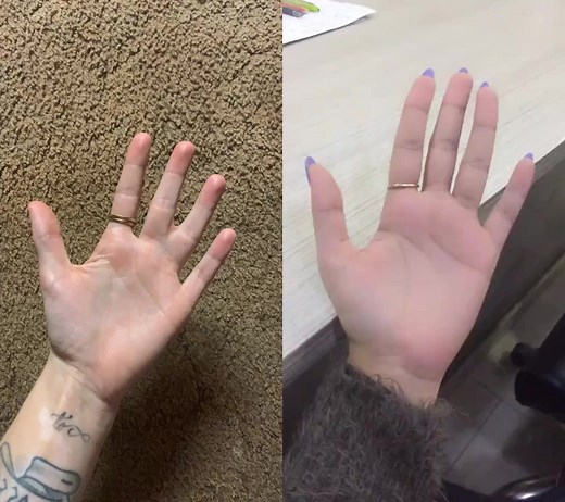Transformation of Webbed Fingers with Finger Tattoo - Before & After